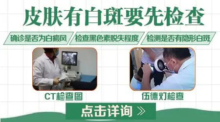 白癜风被误诊的危害-白癜风误诊危害大，正确诊断至关重要