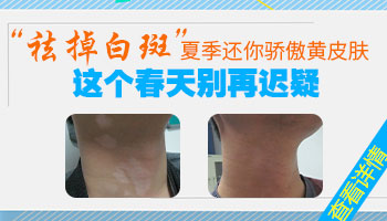 白癜风开始发病时是什么症状