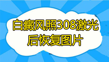 儿童白癜风引起头发发白怎么办