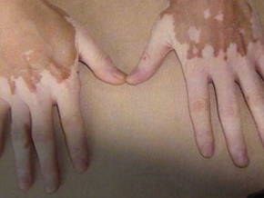 手部皮肤上的白斑要如何护理