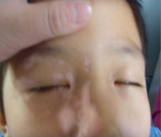 面颈部的早期白癜风的诱发原因