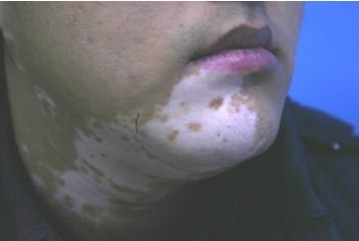 脖子上的白癜风是什么原因引起的