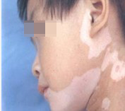 儿童脸上患上白癜风原因是什么