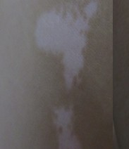 白癜风一般治疗费用多少钱