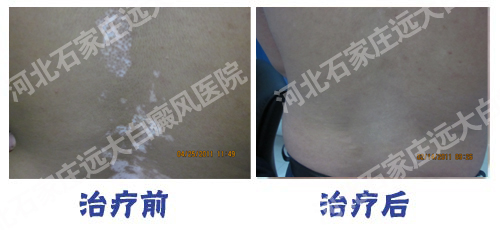 石家庄治疗白癜风好的医院是哪家