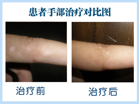 胳膊上长了白癜风如何护理