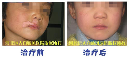 白斑没了，我终于可以和白癜风说goodbye了