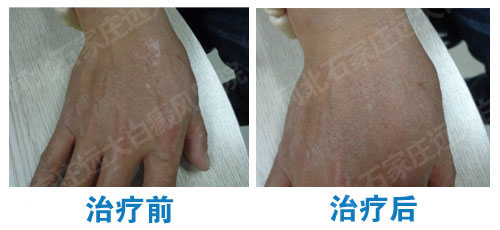 手背上的白癜风怎样才能治好