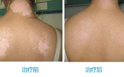 十年白癜风患者获新生远大获赞“技术堪比美国”