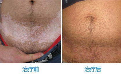 男性腹部白癜风2年 3月快速消除