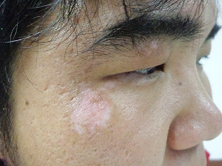 男性面部白癜风