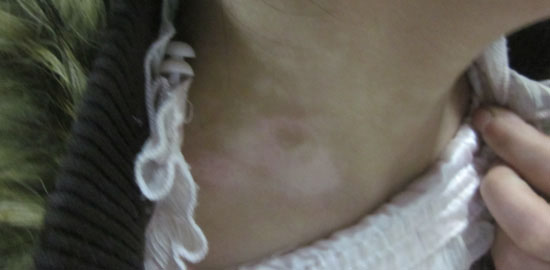 女性颈部白癜风治好