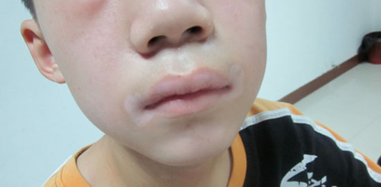 9岁男孩的白癜风在我院治好 父母喜不自禁