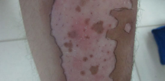 高先生 腿部大面积白癜风治好