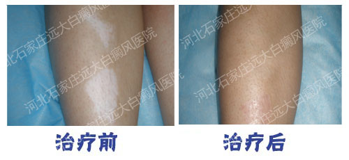 石家庄好的白癜风医院是哪家