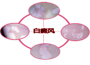 白癜风百科