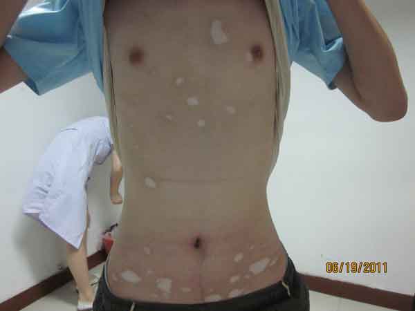 得了白癜风怎么办?有什么好的疗法?