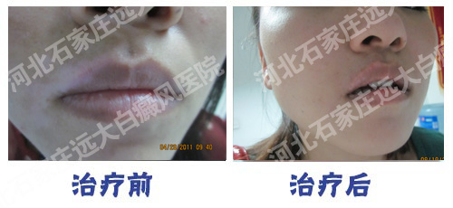 专治白癜风的医院哪里有?
