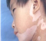五岁大的宝宝脸上长白癜风是什么症状