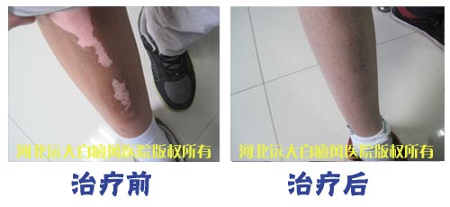 308准分子治疗仪治疗效果怎么样