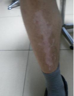 腿上白癜风疾病能不能治疗好