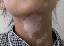 脖子上长了白癜风有哪些办法能治好？