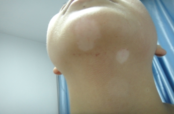 女性白癜风患者在治疗白斑的时候注意什么