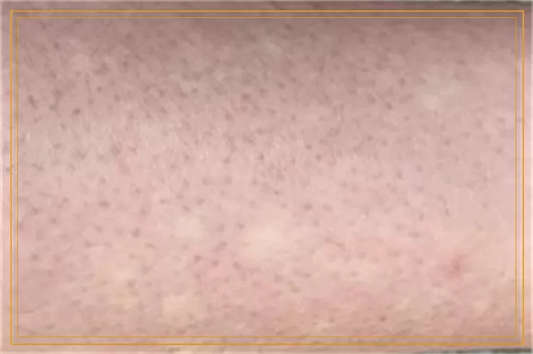 为什么白癜风误诊率高