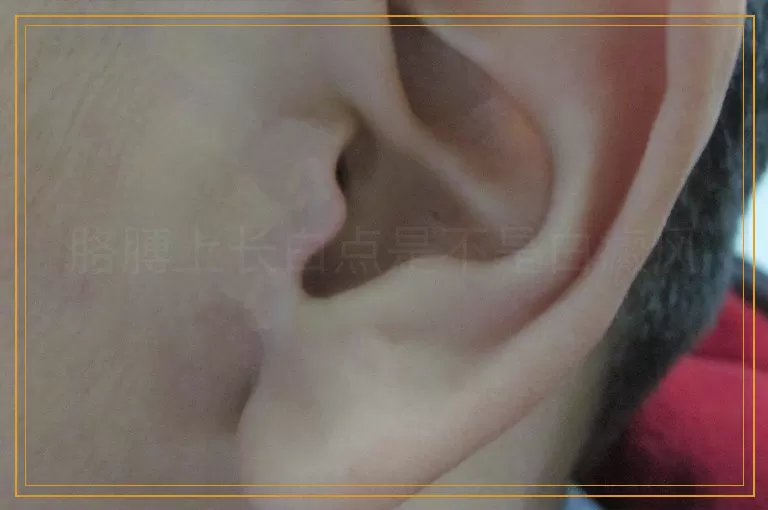 胳膊上长白点是不是白癜风