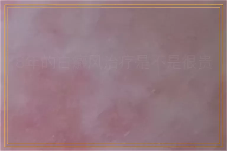 8年的白癜风治疗是不是很贵