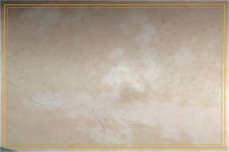 胸口部位出现了一个小白斑是什么