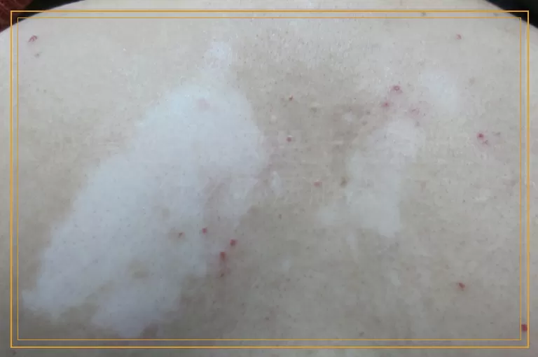 肢端型白癜风是什么原因有什么办法解决