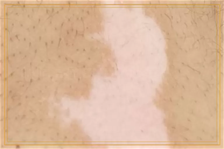 眼睛周围的白癜风怎么治疗