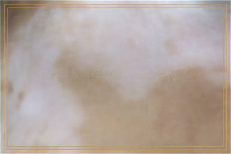 白癜风传染方式是什么