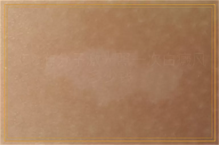 308准分子激光照一次白癜风多少钱