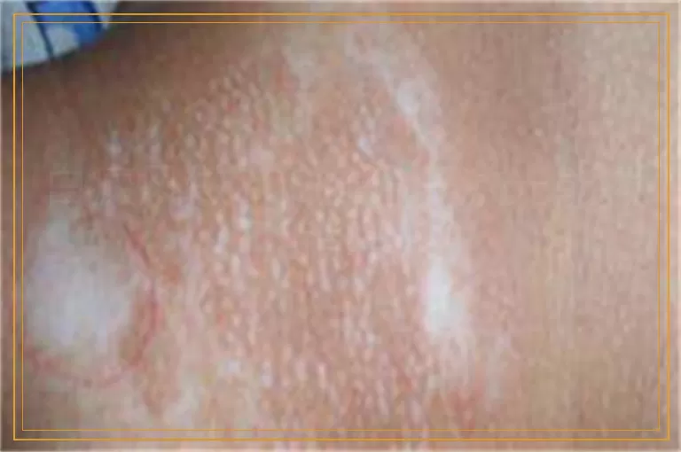 白癜风做308准分子激光能报销吗