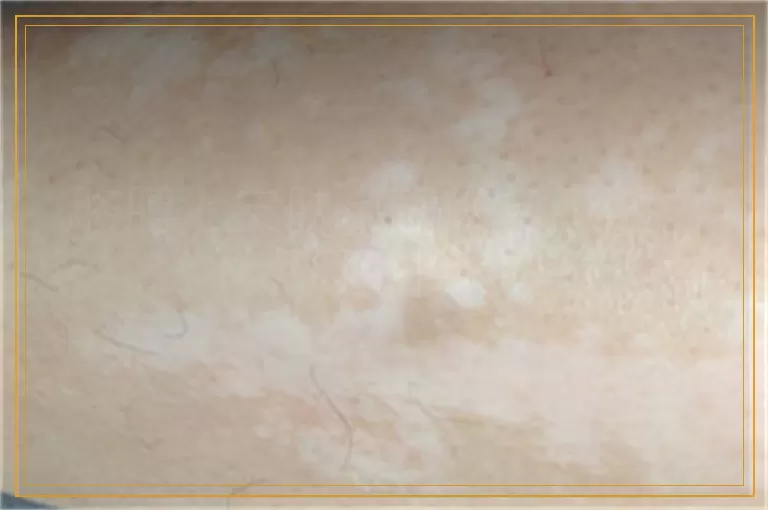 胳膊上皮肤出现许多小圆白点怎么回事