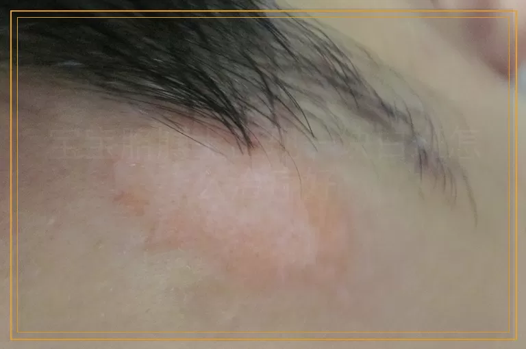 宝宝胳膊上出现一块白斑怎么治疗好