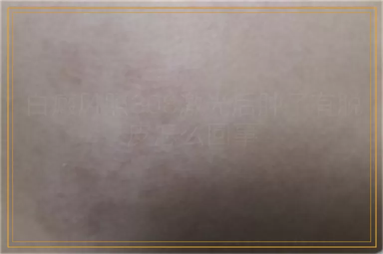 白癜风照308激光后肿了有脱皮怎么回事