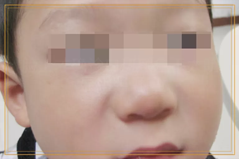 脸上才确诊白斑颜色不太明显用照灯吗