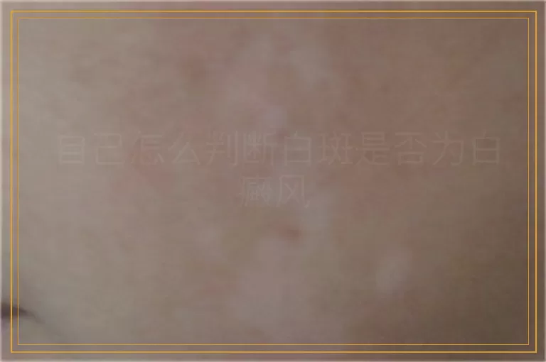 自己怎么判断白斑是否为白癜风