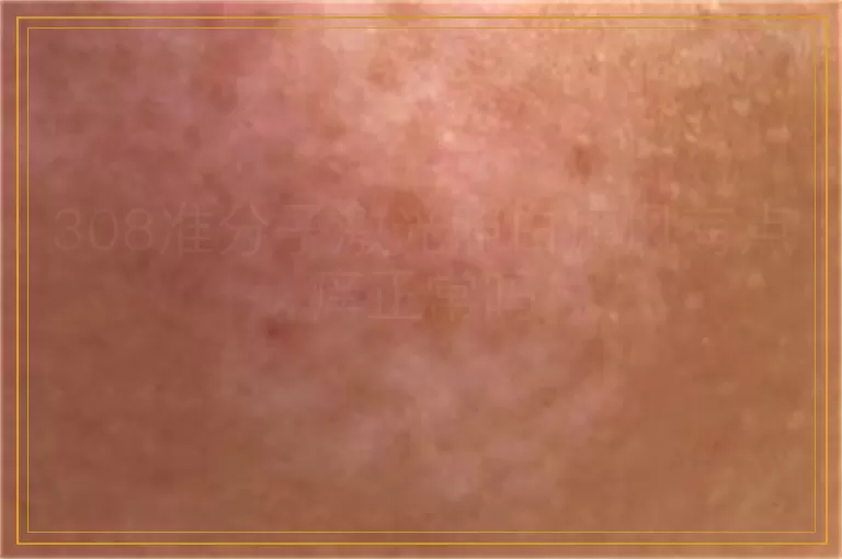 308准分子激光照白癜风有点痒正常吗