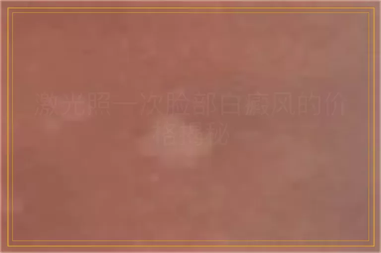 激光照一次脸部白癜风的价格揭秘
