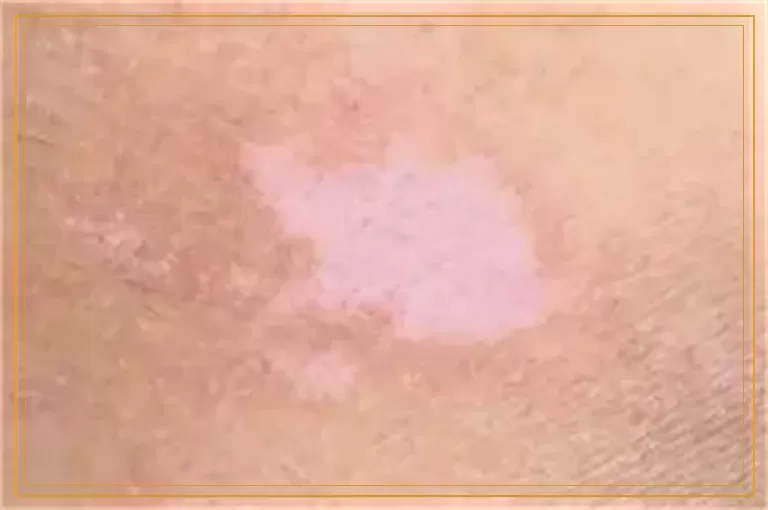 后背白癜风做完植皮多久可以照308激光