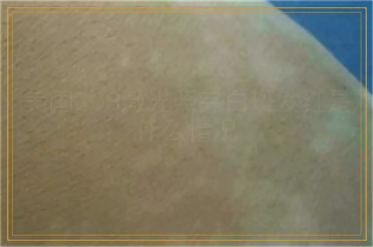 美国308激光照完白斑发红是什么情况