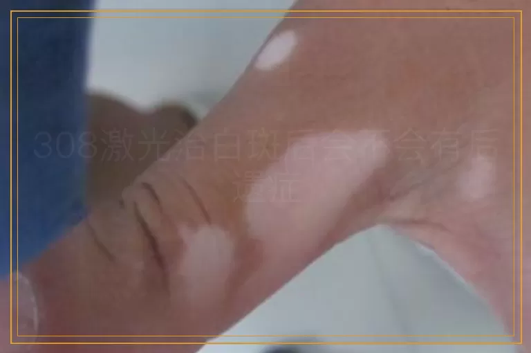 308激光治白斑后会不会有后遗症