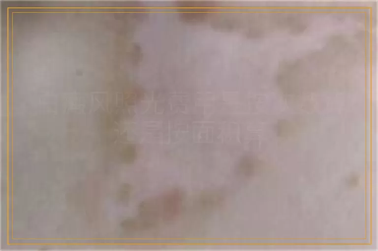 白癜风照光费用是按次数算还是按面积算