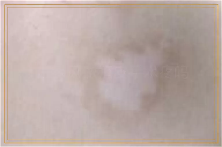 白癜风做植皮手术疼吗