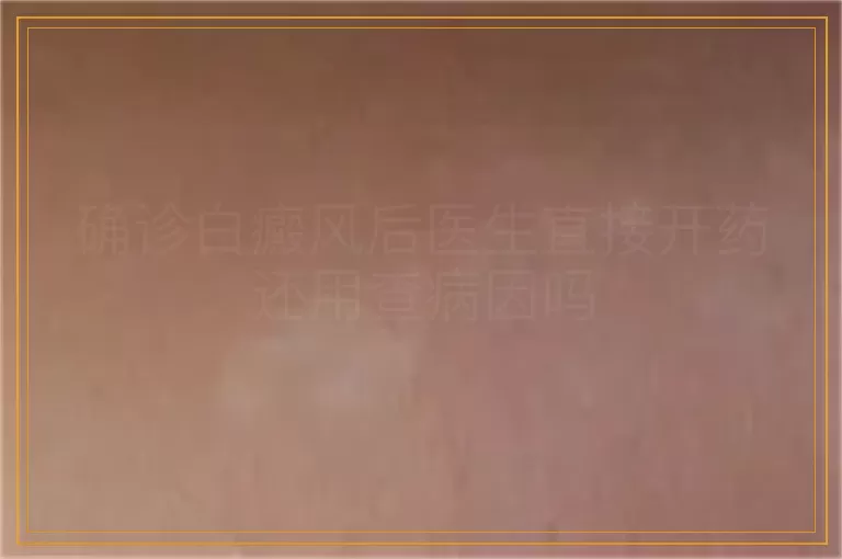 确诊白癜风后医生直接开药还用查病因吗