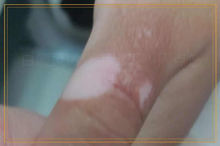 白癜风激光后出现小黑点怎么回事
